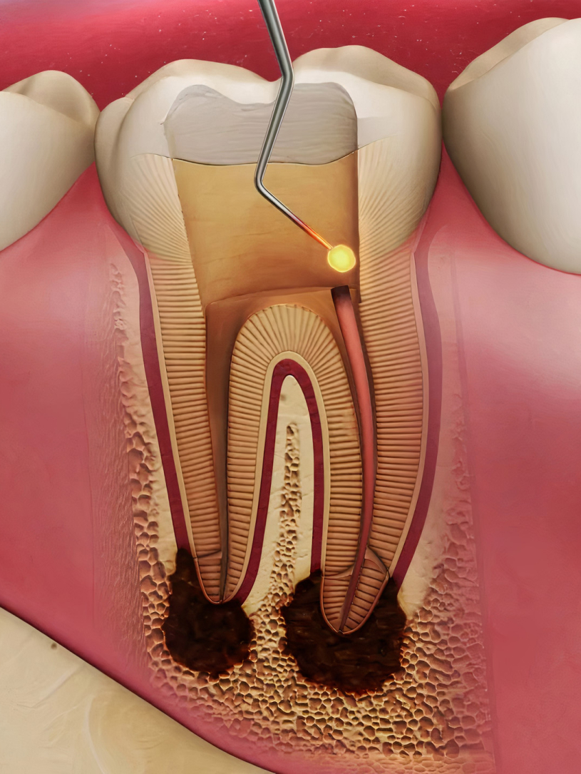 tratamentul endodontic la naturalsmile